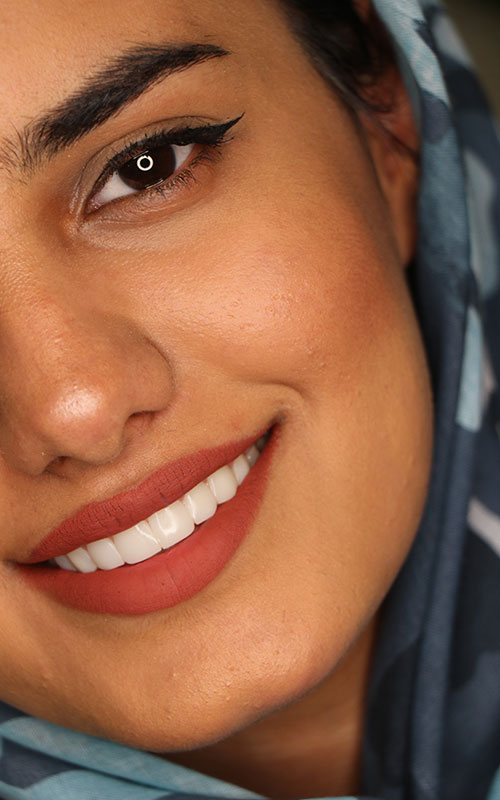 نمونه کار کامپوزیت ونییر